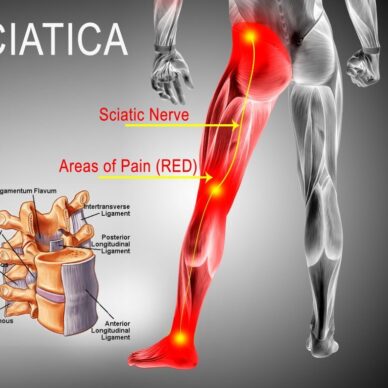 sciatica-pain-colorado-pain-care-blog-1024x768
